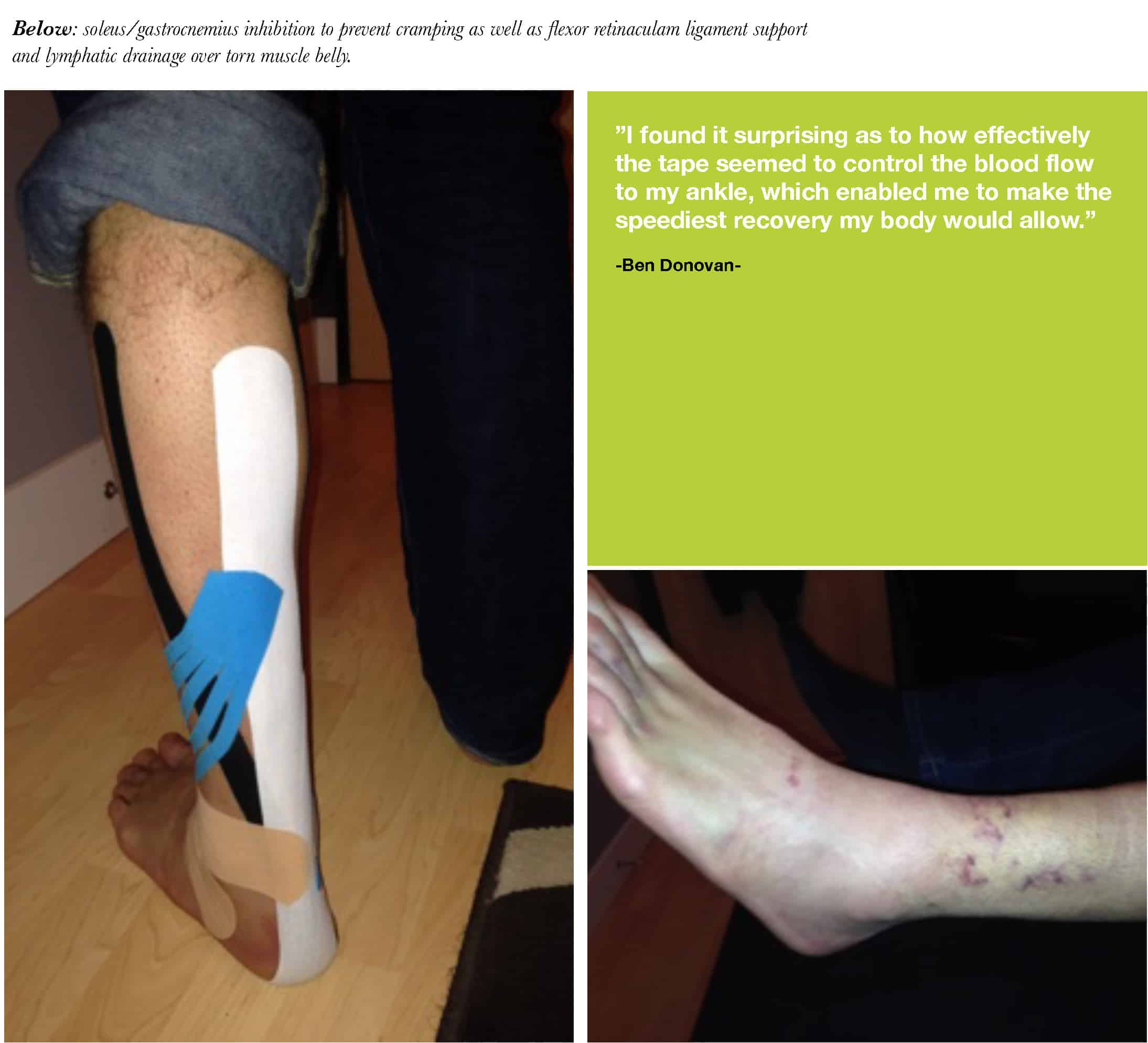 Kinesio Tex Tape used for high ankle sprain treatment of Oscar Blues FC  PASL player Ben Donovan. - Kinesio Tape