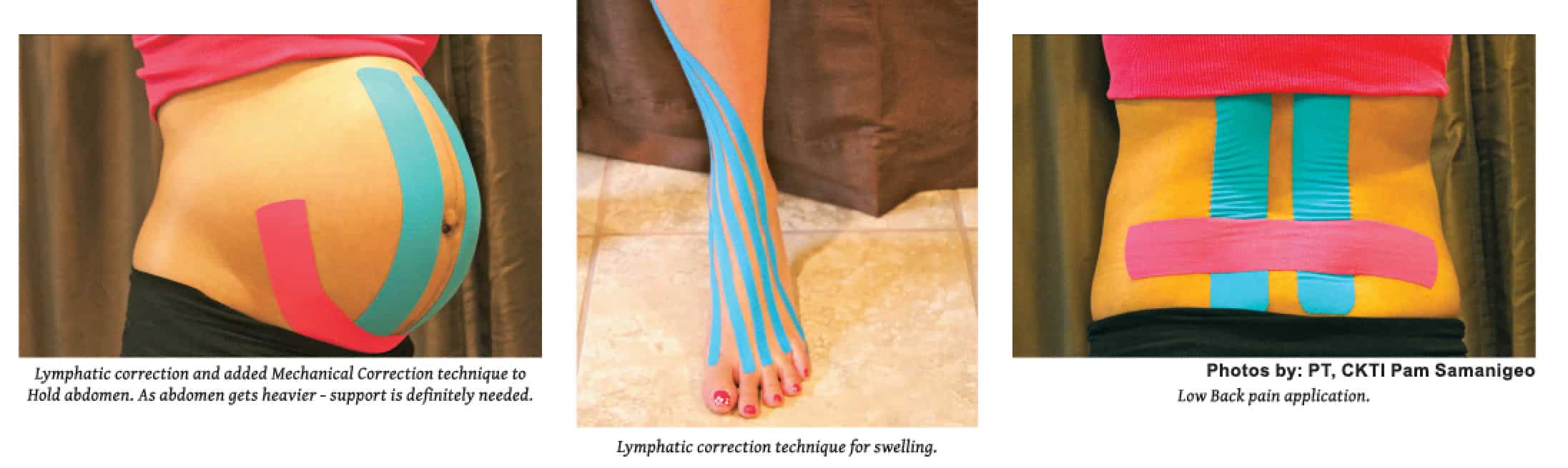 Kinesiotaping for Pregnancy! How KT tape can Help with Rib Pain