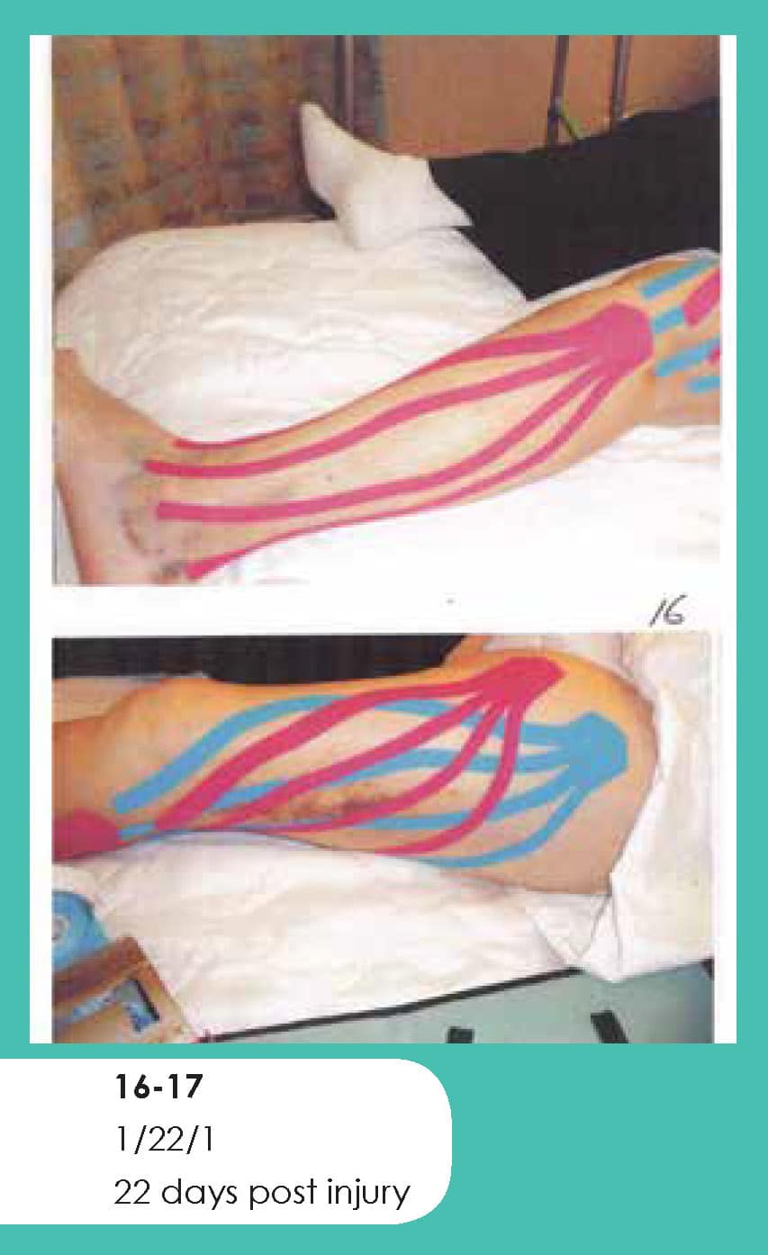 Kinesio Taping Of Superficial Lower Extremity Lymphatic Pathways