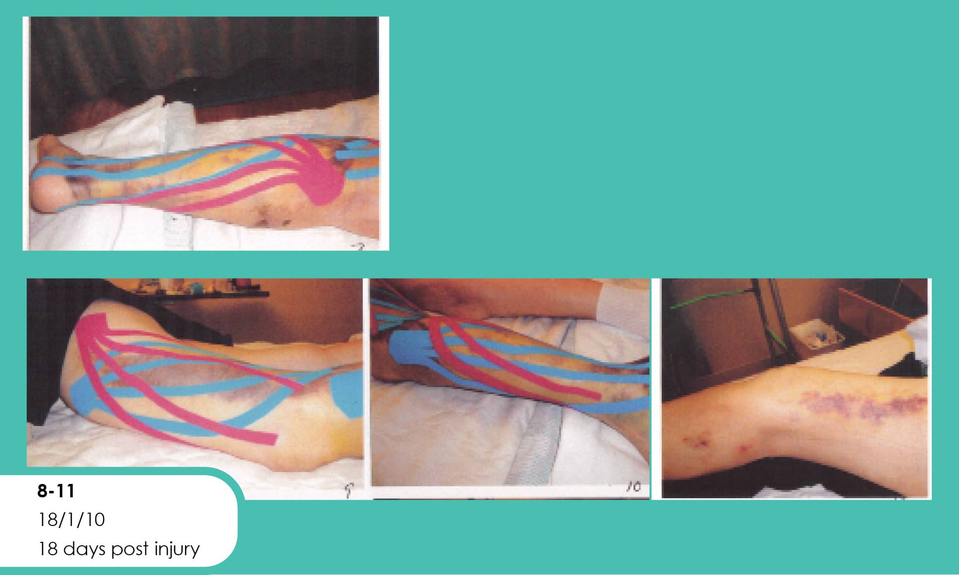 Kinesio Taping Of Superficial Lower Extremity Lymphatic Pathways