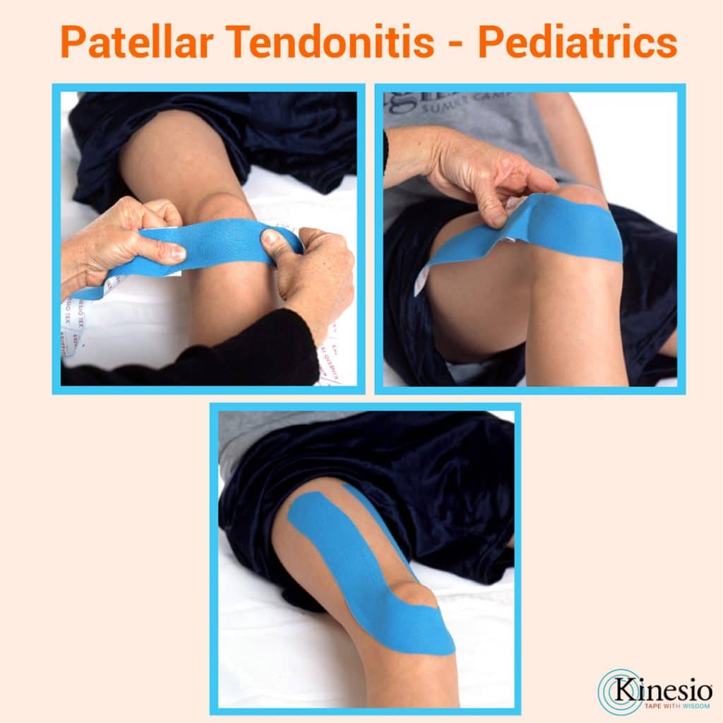 KinesioTapePediatricsPatellarTendonitis Kinesio