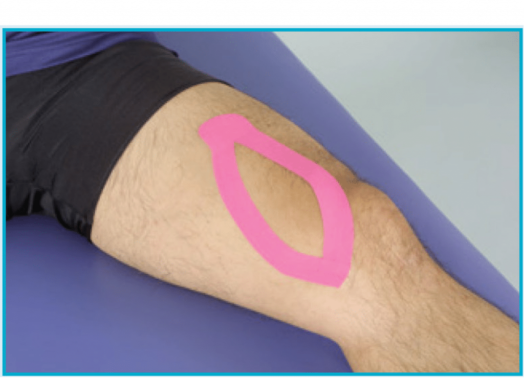 Chondromalacia Patella Kinesio