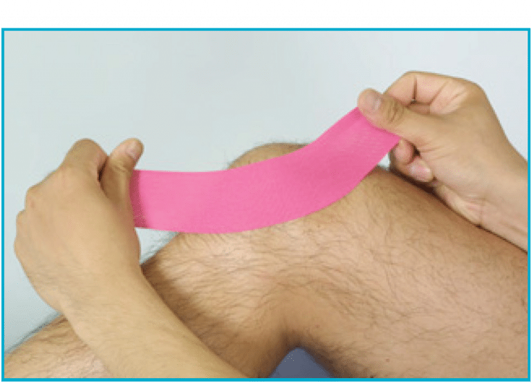Chondromalacia Patella Kinesio