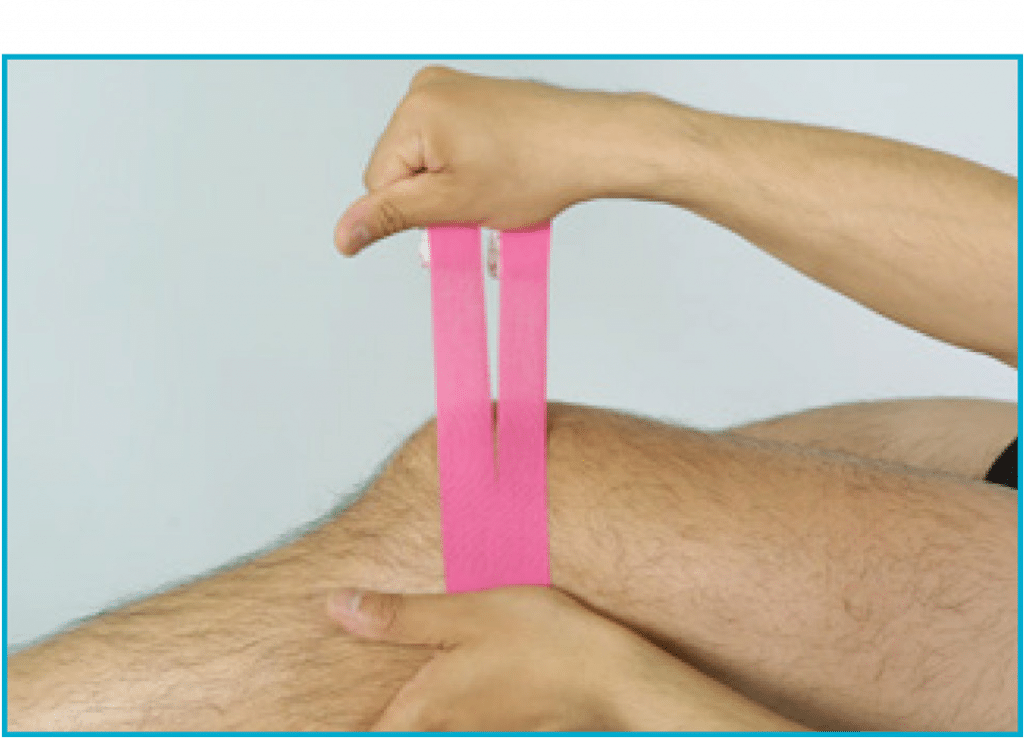 Chondromalacia Patella Kinesio