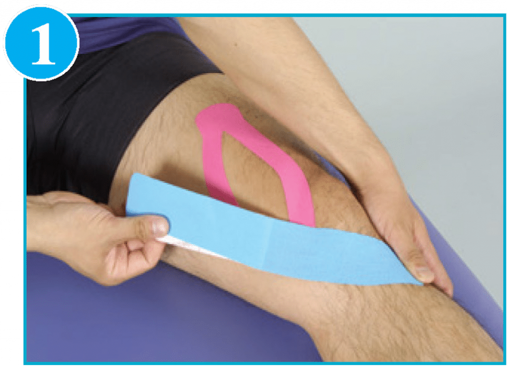 Chondromalacia Patella Kinesio