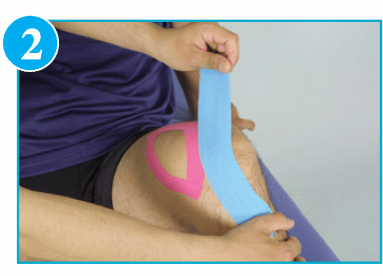 Chondromalacia Patella Kinesio