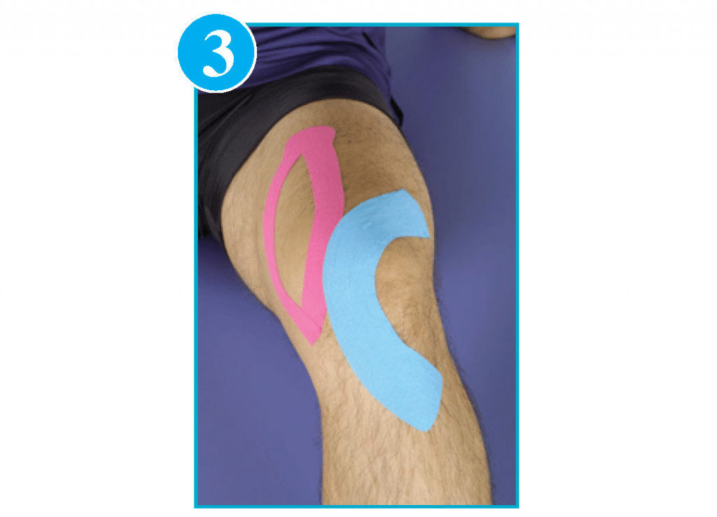 Chondromalacia Patella Kinesio