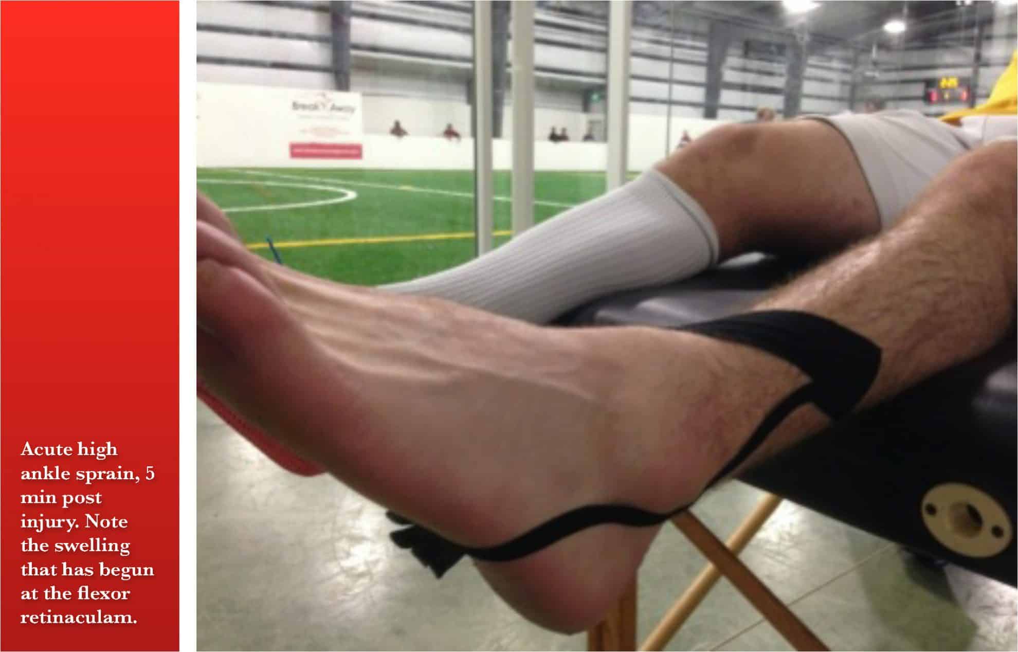 Kinesio Tex Tape used for high ankle sprain treatment of Oscar Blues FC
